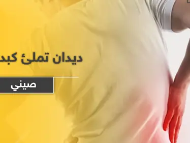 بالصور|| ديدان تملئ كبد رجل صيني.. والأطباء يضطرون لإستئصال جزء كبير منه ويوضحون الأسباب - وكالة ستيب نيوز