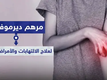 مرهم ديرموفيت Dermovate لعلاج الالتهابات والأمراض الجلدية - وكالة ستيب نيوز