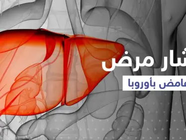 مرض غامض بالكبد يصيب أطفالاً في 12 بلداً..
