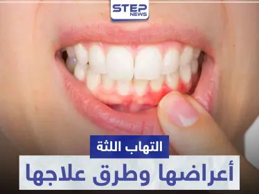 تعرّف على أكثر من كبسول لعلاج التهاب اللثة و ما هي أسبابها وأعراضها - وكالة ستيب نيوز