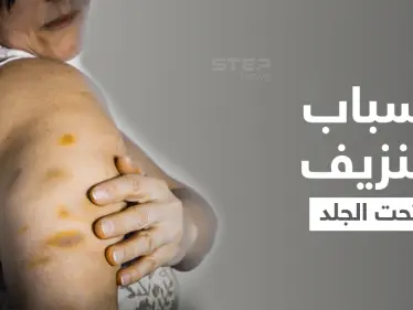 نزيف تحت الجلد... علامات أرجوانية أشبه بالكدمات على الجسم ما هي أسبابها وطرق علاجها - وكالة ستيب نيوز