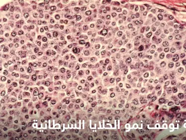 علماء يكتشفون أطعمة توقف نمو الخلايا السرطانية في الجسم وتمنع انتشارها - وكالة ستيب نيوز