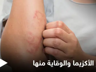 هل تنتشر الأكزيما في الجسم.. وطرق الوقاية منها إليك أهم المعلومات - وكالة ستيب نيوز