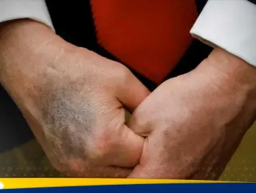 شاهد|| كدمات داكنة على يد ترامب تثير المخاوف مجدداً حول صحته - وكالة ستيب نيوز