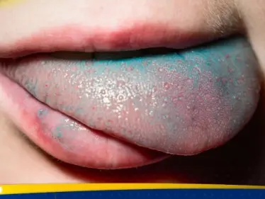 رصد أول حالة لفيروس اللسان الأزرق في أوروبا - وكالة ستيب نيوز