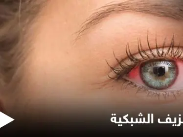 تعرف على علاج نزيف الشبكية بالحقن وطرق أخرى - وكالة ستيب نيوز