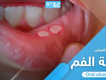 علاج قرحة الفم في المنزل.. إليك الطريقة و7 نصائح هامة - وكالة ستيب نيوز