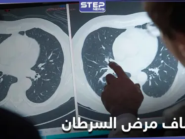 علامة تنذر بوجود أورام سرطانية في الجسم قبل ظهورها.. وتمكن من اكتشافها مبكراً - وكالة ستيب نيوز