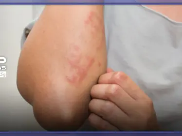 لوراتادين الجيل الـ 2 من مضادات مستقبلات الهيستامين.. الاستطبابات والجرعة الدوائية - وكالة ستيب نيوز