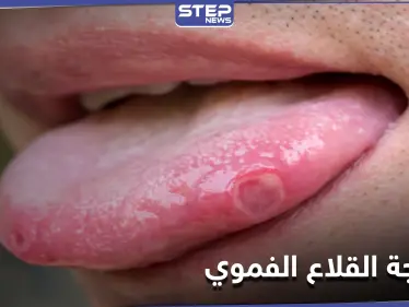 علاجات منزلية مذهلة للتخلص من القلاع الفموي بشكل طبيعي.. إليك 4 طرق - وكالة ستيب نيوز