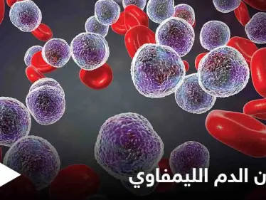 ما هو سرطان الدم الليمفاوي وكيف تظهر أعراضه على المريض إليك أهم المعلومات - وكالة ستيب نيوز