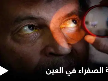 تعرف على أسباب ظهور اللطخة الصفراء في العين وعلاجاتها - وكالة ستيب نيوز