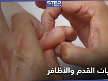 لإيقاف خطر الإصابة بمرض فطريات القدم والأظافر.. إليك 7 نصائح لمكافحته - وكالة ستيب نيوز