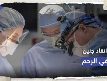 الأولى من نوعها.. جراحة ناجحة لدماغ جنين برحم أمه - وكالة ستيب نيوز