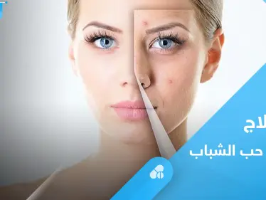 متى يترك حب الشباب ندباً وما الطريقة الأفضل لعلاجه.. إليك رأي الخبراء - وكالة ستيب نيوز