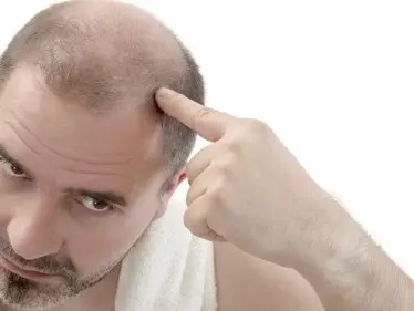 5 أسباب رئيسية تؤدي إلى تساقط الشعر - وكالة ستيب نيوز