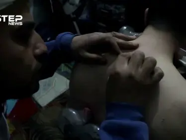 تعرف على الحجامة في مدينة الباب بريف حلب - وكالة ستيب نيوز