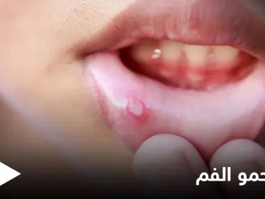 ما هي أسباب ظهور حمو الفم ومتى يكون خطيراً ويحتاج إلى التدخل الطبي إليك أهم المعلومات - وكالة ستيب نيوز