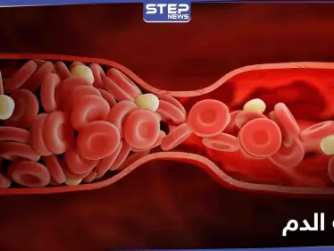 أعراض جلطة الدم وأخطارها وطرق الوقاية منها - وكالة ستيب نيوز