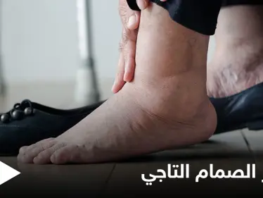 منها تورم القدمين.. تعرف على أعراض قصور الصمام التاجي وأسبابه وطرق العلاج - وكالة ستيب نيوز