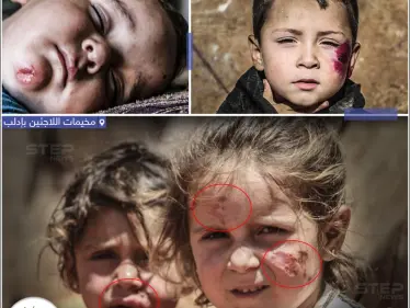 انتشار داء الليشمانيا بين اللاجئيين السوريين في مخيمات النزوح بإدلب - وكالة ستيب نيوز