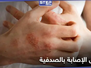 الصدفية تزداد في الفترة الأخيرة.. وهؤلاء الأشخاص هم الأكثر عرضة للإصابة بها - وكالة ستيب نيوز