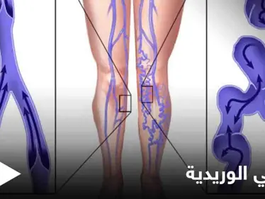 يسبب الكثير من الأعراض المزعجة.. تعرف على مرض الدوالي الوريدية وأسبابه وطرق الوقاية منه - وكالة ستيب نيوز