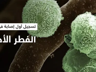 الهند تسجل أول إصابة بالفطر الأخضر في العالم.. وطبيب يشرح أعراضه - وكالة ستيب نيوز