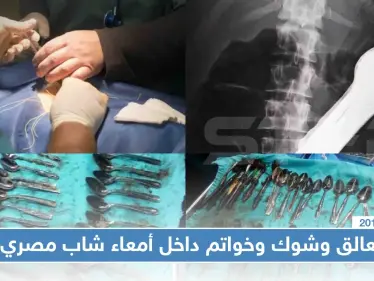 شاب مصري اشتكت والدته من فقدان المعالق والشوك وخاتم ذهبي، فعُثر عليهم داخل معدته!! (صور) - وكالة ستيب نيوز