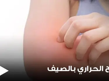 الطفح الحراري في الصيف أعراضه وأسبابه وطرق علاجه - وكالة ستيب نيوز