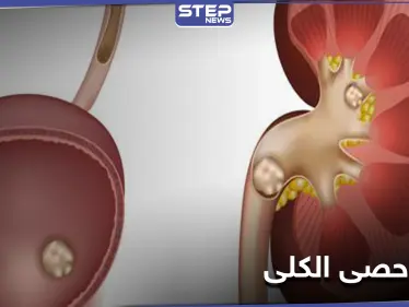 ما لا تعرفه عن حصى الكلى وكيف يمكن معالجتها بالوسائل المنزلية البسيطة - وكالة ستيب نيوز