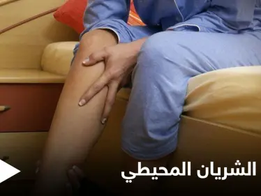 مرض الشريان المحيطي مشكلة صحية تصيب الأطراف وتتسبب بضعفها تعرف عليه - وكالة ستيب نيوز