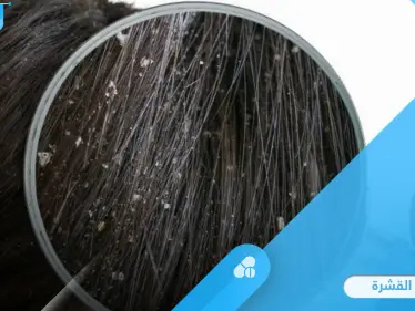 طرق سهلة لعلاج القشرة في المنزل وأسباب ظهورها والوقاية منها - وكالة ستيب نيوز