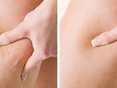 عملية إزالة السيلوليت.. مع تعريفه وطرق إزلته بالليزر بتقنية حديثة - وكالة ستيب نيوز