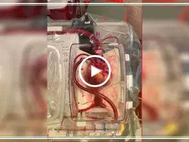 في خطوة قد تنقذ الآلاف.. أطباء ينجحون بإعادة النبض إلى قلب ميت (فيديو) - وكالة ستيب نيوز