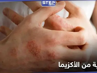ماهي الأكزيما.. أسباب حدوثها وأهم الطرق للوقاية منها - وكالة ستيب نيوز
