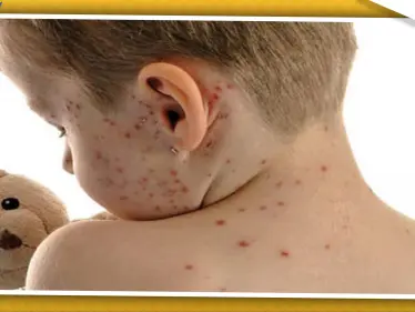 الجرب ينتشر في إسطنبول.. والصحة التركية تحذّر المواطنين - وكالة ستيب نيوز