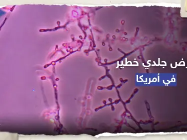 معدي ومقاوم للأدوية.. تسجيل أول إصابتين بمرض جلدي خطير في أمريكا - وكالة ستيب نيوز