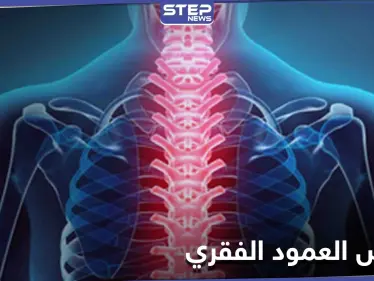 منها السُمنة.. تعرف على أسباب الأمراض التي تصيب العمود الفقري ومدى خطورتها وطرق العلاج - وكالة ستيب نيوز