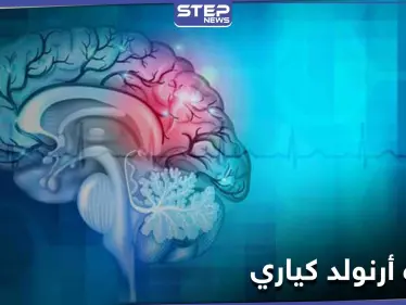ماذا تعرف عن تشوه أرنولد كياري وأثره على النخاع الشوكي والحركة العضلية - وكالة ستيب نيوز