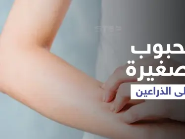 أسباب ظهور حبوب صغيرة على الذراعين وطرق علاجها إليك أهم المعلومات - وكالة ستيب نيوز