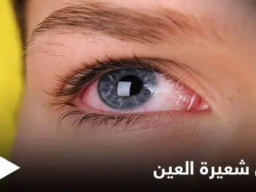 ما هي شعيرة العين وأسباب ظهورها إليك أهم المعلومات - وكالة ستيب نيوز