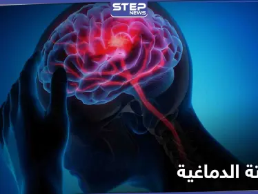 السكتة الدماغية تنهي حياة أعداد كبيرة يومياً.. أعراضها وطرق الوقاية منها - وكالة ستيب نيوز