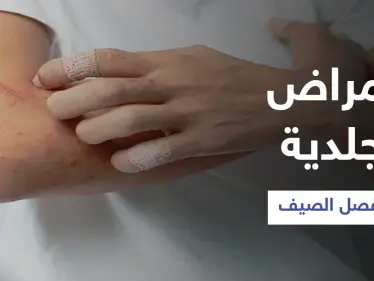 تعرّف على أبرز الأمراض الجلدية الشائعة في فصل الصيف وطرق الوقاية منها - وكالة ستيب نيوز