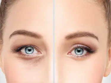 عمليات تجميل العيون .. أنواعها تكلفتها ومخاطرها - وكالة ستيب نيوز