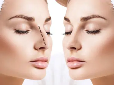 طريقة عملية تجميل الانف وخطوات إجرائها بالتفصيل.. فوائد وأضرار - وكالة ستيب نيوز