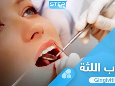 5 من افضل ادوية علاج التهاب اللثة المتعارف عليها إليك بها - وكالة ستيب نيوز