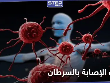 إجراءات تساعد على تجنب الإصابة بالسرطان والتعرّف عليه بمرحلة مبكرة - وكالة ستيب نيوز