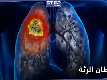 أورام غير متوقعة قد تكون دليلًا على الإصابة بـ سرطان الرئة - وكالة ستيب نيوز