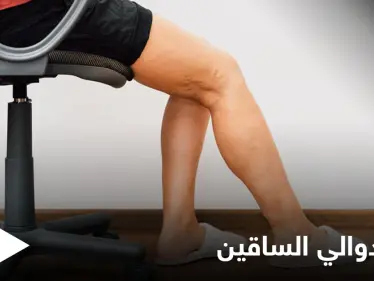 تعرف على أهم الوصفات الطبيعية لعلاج دوالي الساقين - وكالة ستيب نيوز